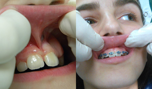 Oral surgery, frenuloplasty)